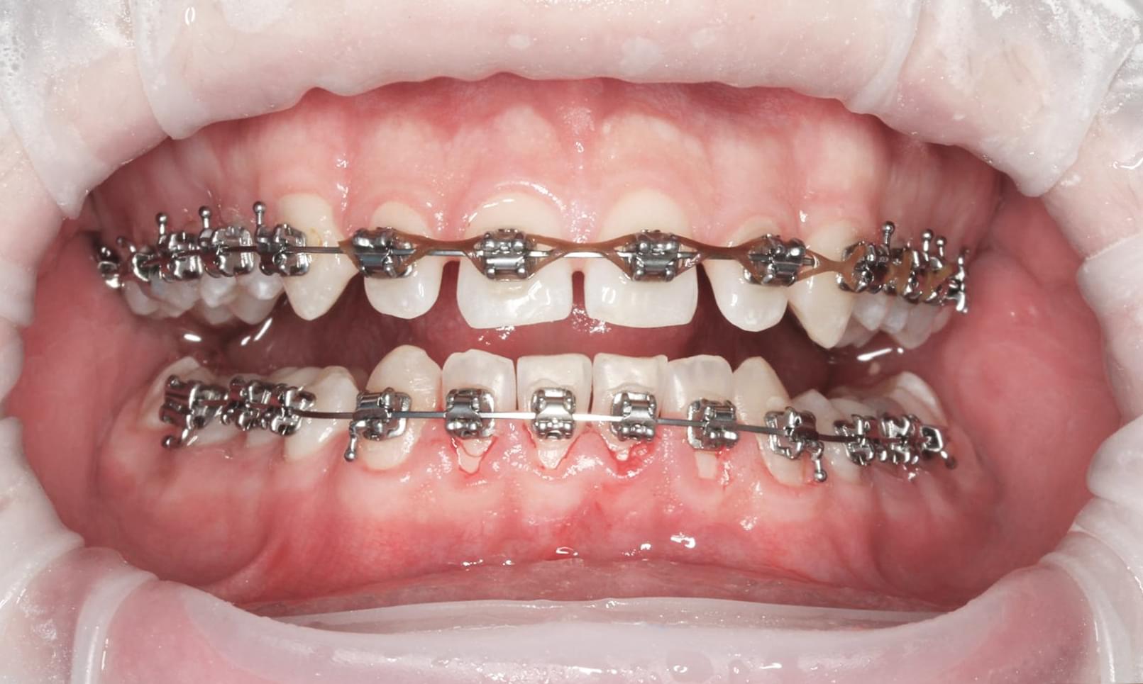 teeth after