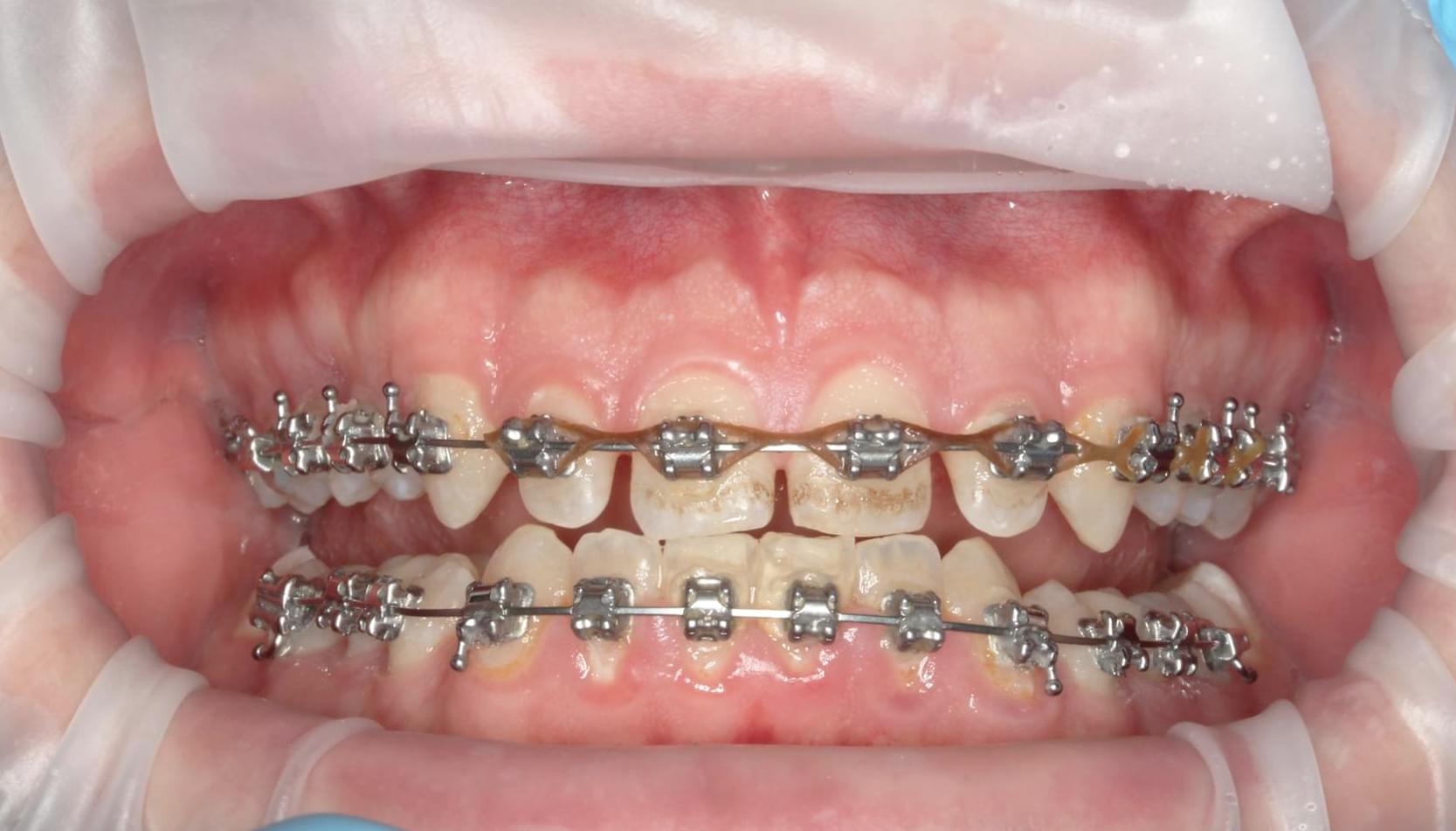 teeth before