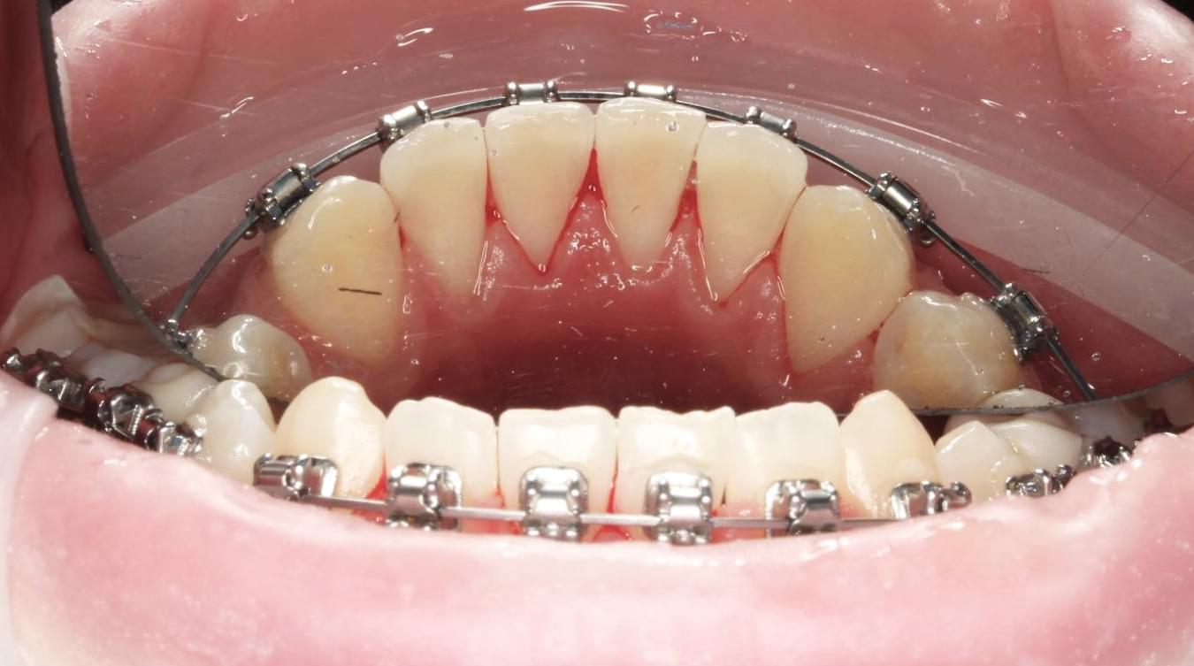 teeth after