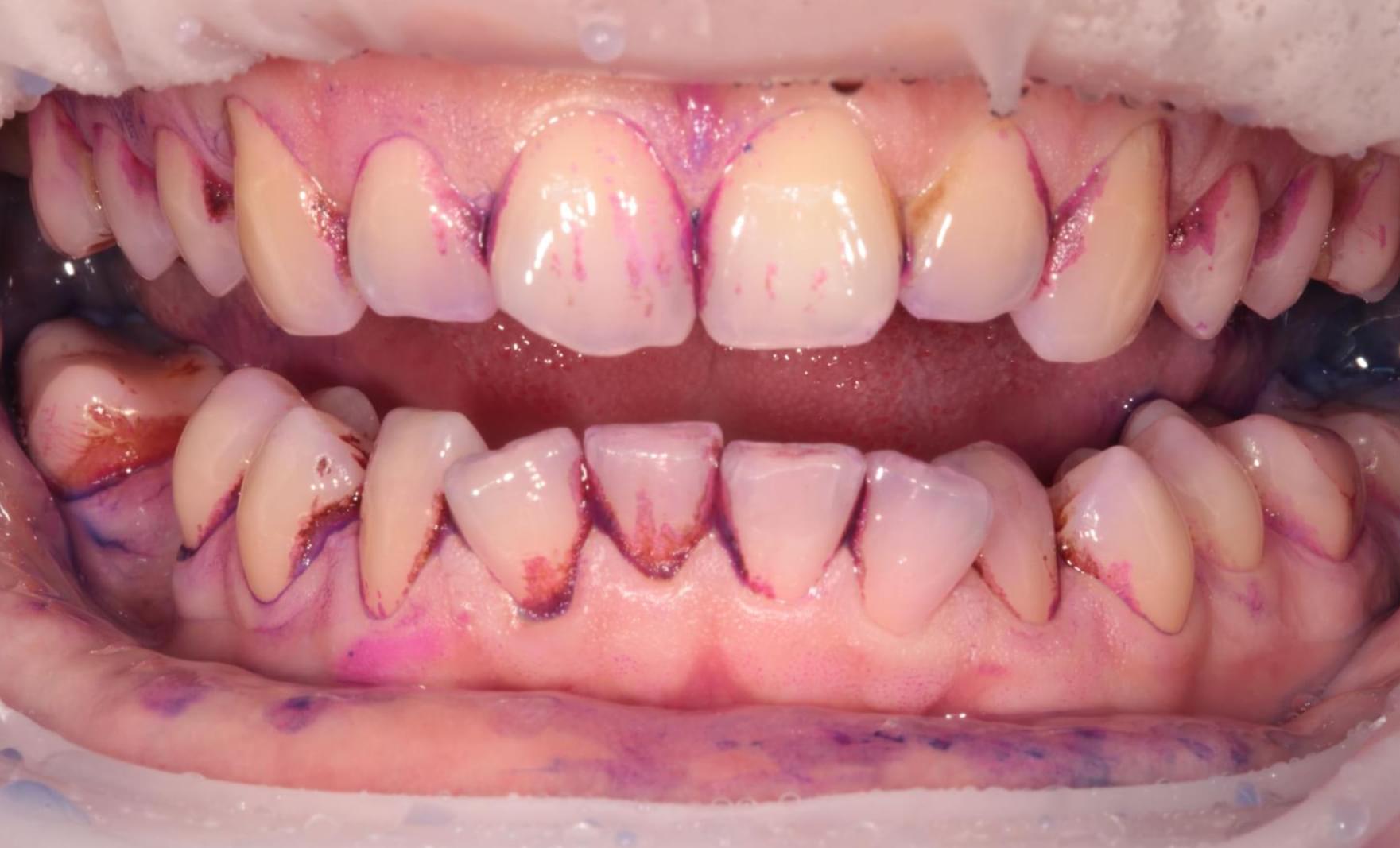 teeth after