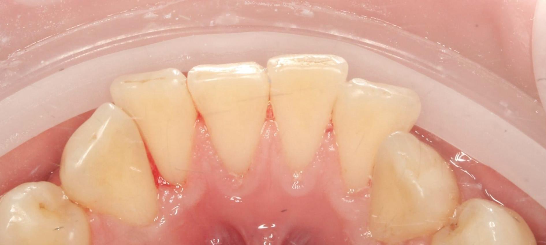 teeth after