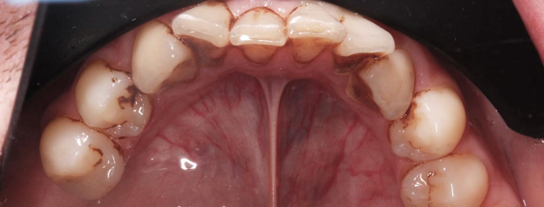 teeth before