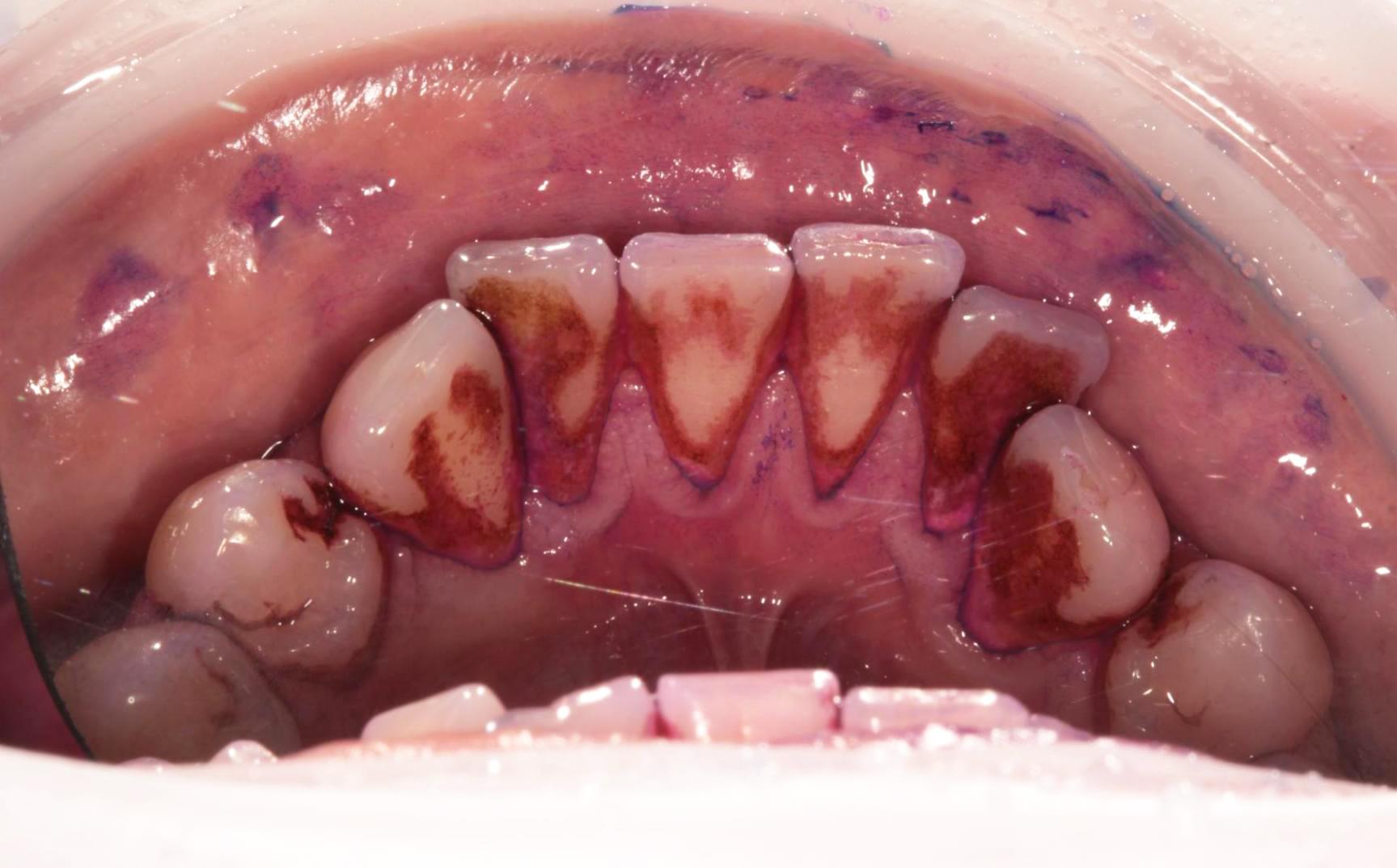 teeth after