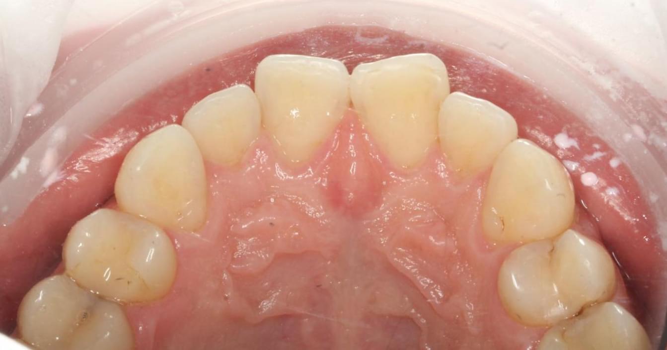 teeth after
