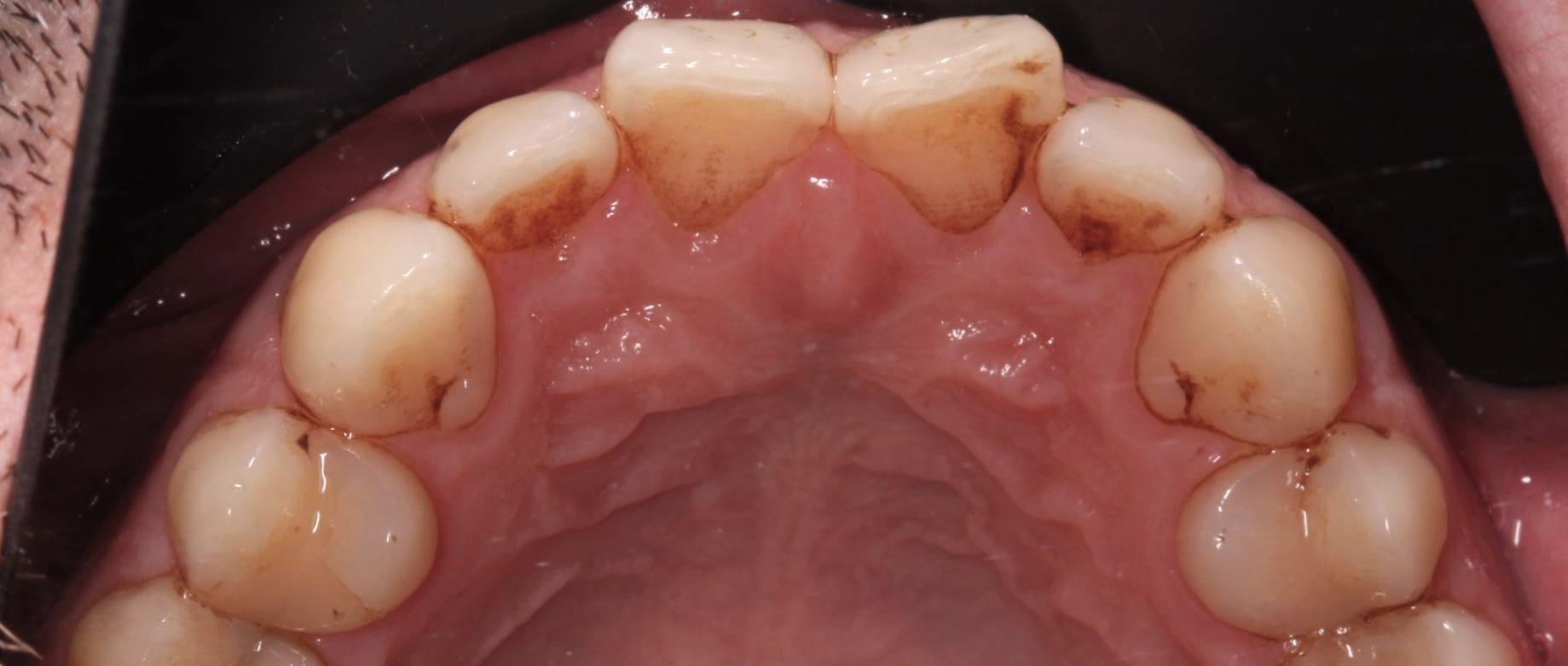 teeth before